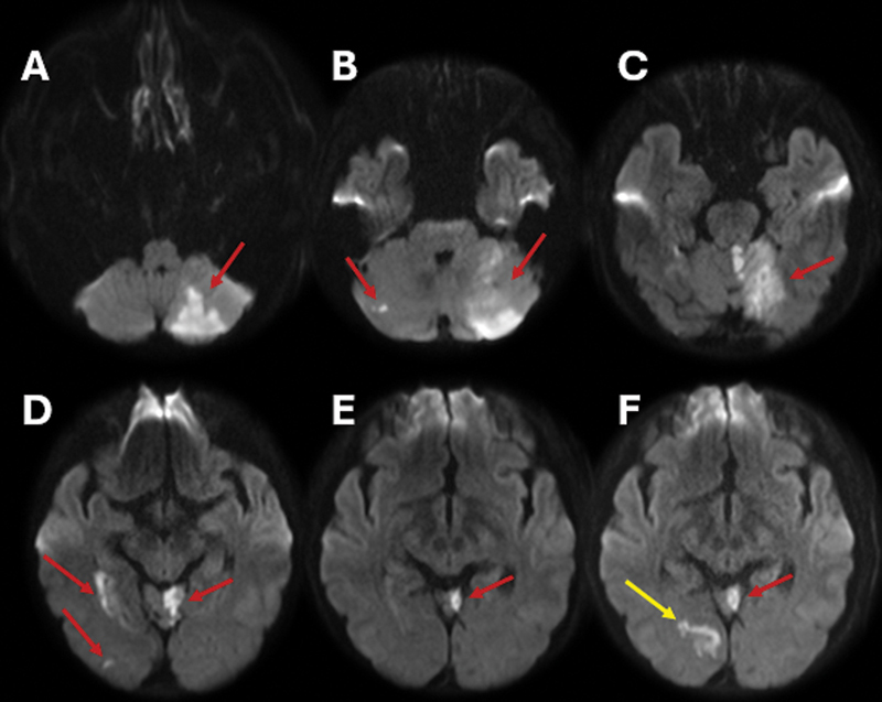 Unmasking vertebral artery stump syndrome in recurrent posterior strokes treated with endovascular therapy.