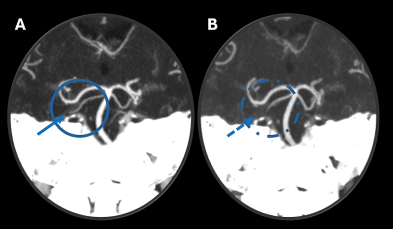 Unmasking vertebral artery stump syndrome in recurrent posterior strokes treated with endovascular therapy.