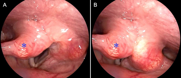 Unusual nodular goiter with recurrent laryngeal nerve palsy due to severe degeneration caused by intense chronic inflammation: a case report with histopathological evidence and review of the literature.