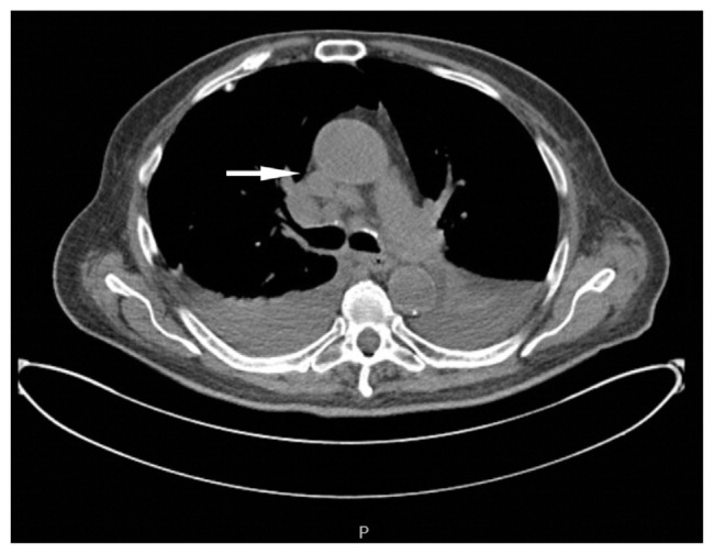 Beyond the Bowel: Lung Cancer Presenting as Complicated Diverticulitis.