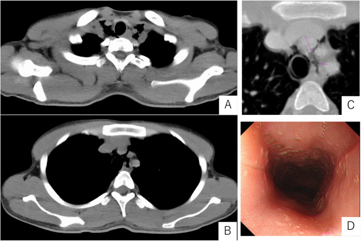 Hamman's syndrome in a patient with uncontrolled type 1 diabetes mellitus: a case report.