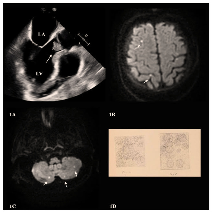 Pneumococcal Endocarditis: Historical Insights and Modern Challenges.
