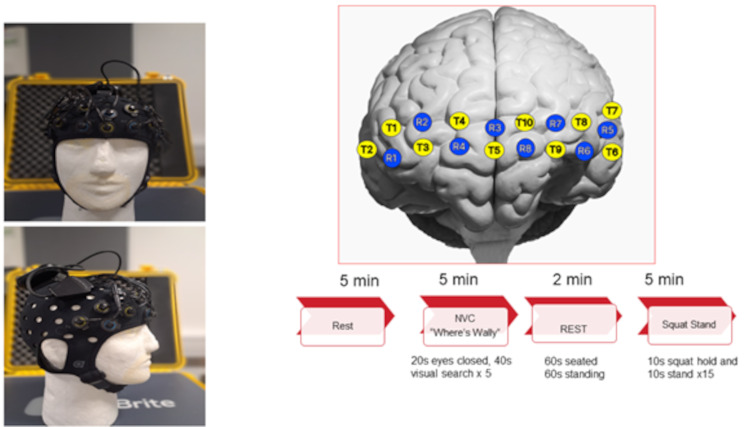 Cerebral Haemodynamic Assessment Following Sport-related Concussion (Mild Traumatic Brain Injury) in Youth and Amateur Rugby Union Players.
