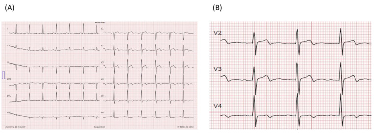 The painless ST-elevation myocardial infarction equivalent: a case report.