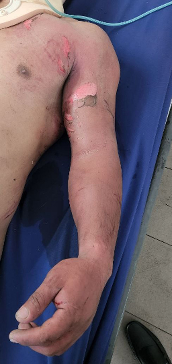 Under pressure: a case of compartment syndrome secondary to crushing injury utilizing Whitesides's apparatus.