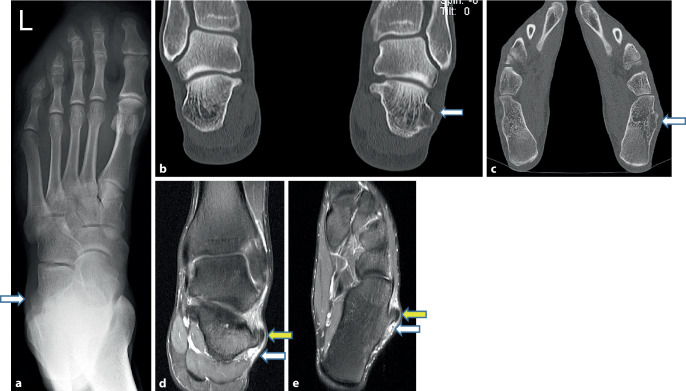 [Pathological rupture of the distal peroneal retinaculum with dislocation of the peroneus longus tendon in a high jump champion : A 15-year case study].