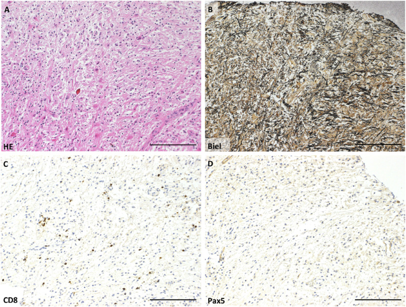 Paraneoplastic Tumefactive Demyelination With Underlying Anaplastic Thyroid Cancer: A Case Report and Review of the Literature.