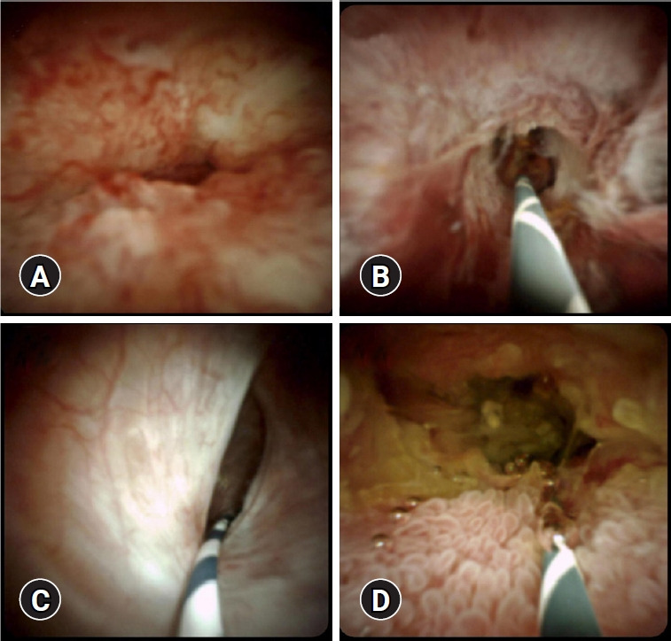 Peroral cholangioscopy: past, present and future.