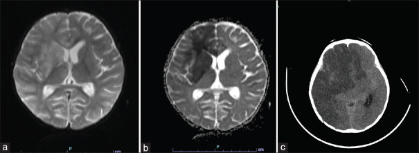 Spectrum of Neurological Manifestations of HHV-6 Encephalitis in Immunocompetent Children - A Retrospective Study at a Tertiary Care Center in South India.