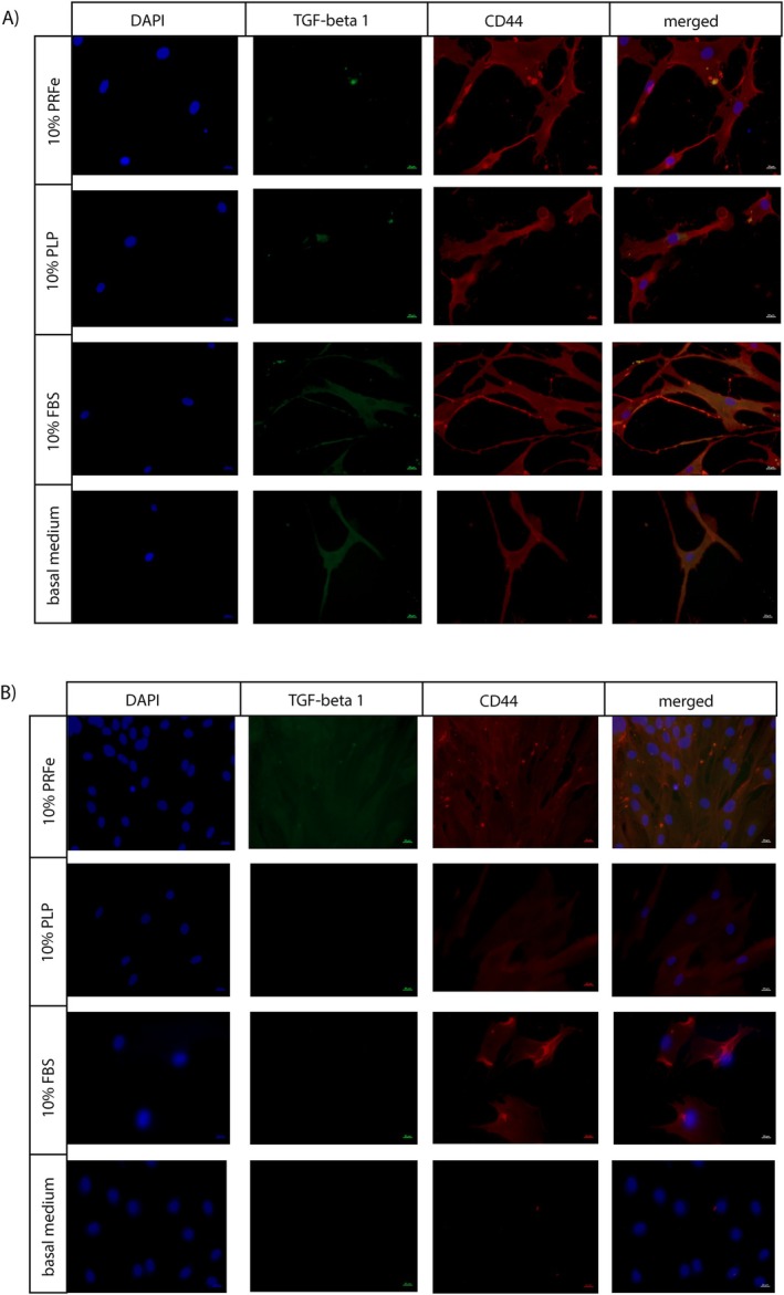 Platelet-Rich Fibrin Mediates Beneficial Effects on Adipose-Derived Stem Cells via Increased Levels of Key Cytokines.