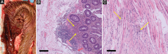 Brown bowel syndrome: a systematic review.
