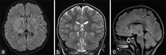 Spectrum of Neurological Manifestations of HHV-6 Encephalitis in Immunocompetent Children - A Retrospective Study at a Tertiary Care Center in South India.