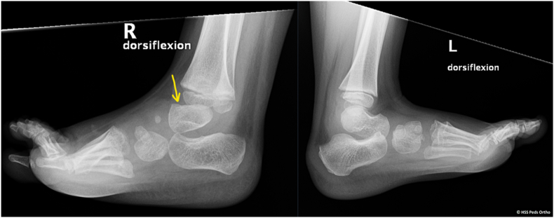 Pearls to Address Challenges in Initial Casting Treatment for Idiopathic Clubfoot.