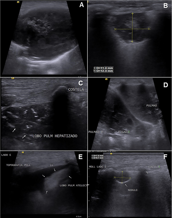 Acoustic Radiation Force Impulse Elastographic Study of Lung Lesions in Dogs.