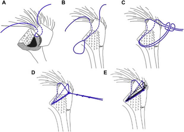 Cow Hitch Cerclage Suture Fixation of the Greater Tuberosity in Reverse Total Shoulder Arthroplasty Performed for Proximal Humerus Fractures: A Retrospective Cohort Study With a Minimum Follow-up of 2 Years.