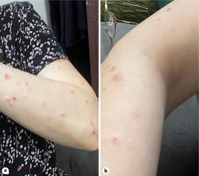 Dupilumab's Successful Journey in Pityriasis Lichenoides Chronica Followed by the Intriguing Reemergence of Vitiligo after Monobenzone Depigmentation: A Case Report.