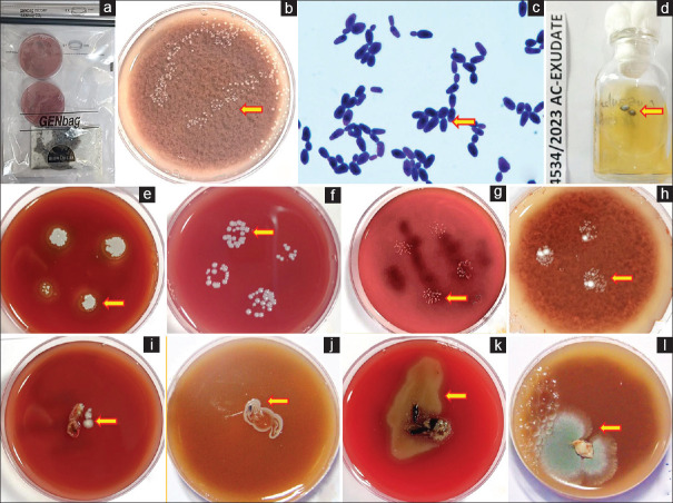 Diagnostic microbiology for intraocular infections: A comprehensive approach.