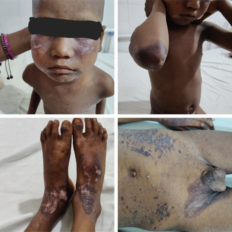 Recurrent Acrodermatitis Enteropathica in a Pediatric Patient: A Rare Case Report with Zinc Deficiency and Complications.
