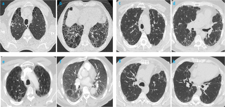 Impact of coal mine dust exposure and cigarette smoking on lung disease in Appalachian coalminers.