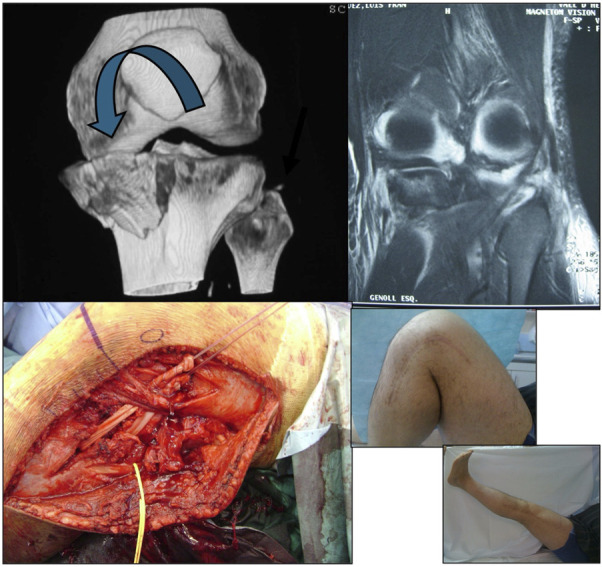 Current concepts in tibial plateau fracture management: a Spanish Orthopaedic Trauma Association review.