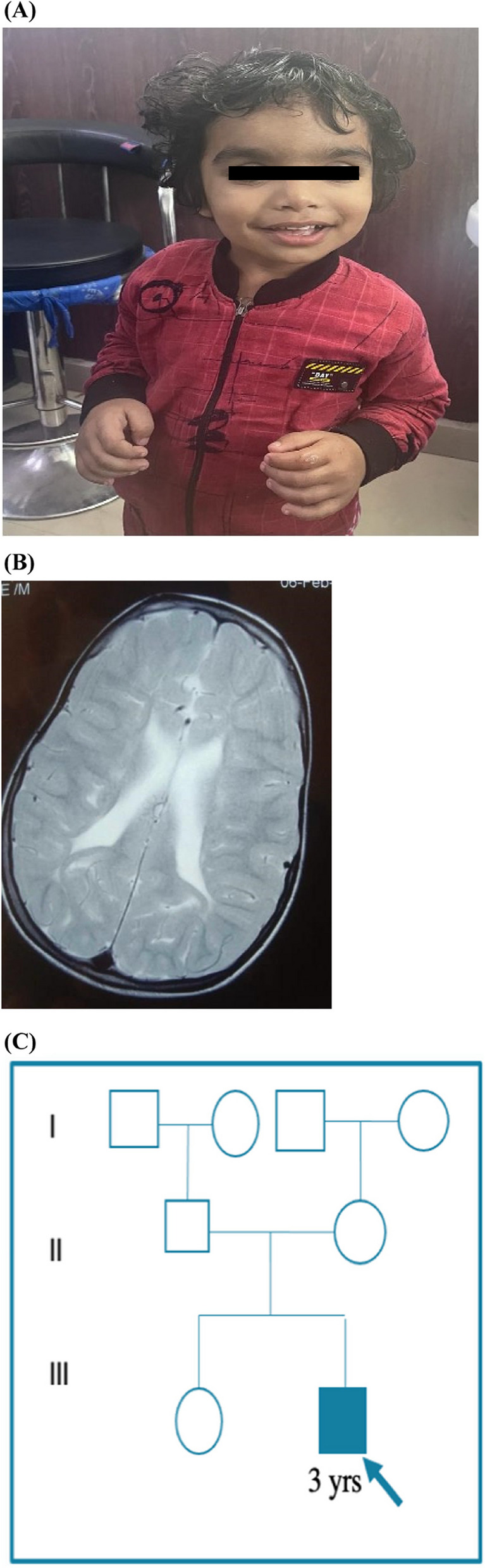 Novel WAC gene variant identified in the first documented case of DeSanto-Shinawi Syndrome in India.