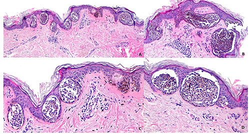Lack of communication between dermatologists and histopathologists in real-life settings: a survey of the Italian Association of Hospital Dermatologists (ADOI).