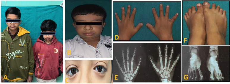 A Rare Case of Pyknodysostosis (Toulouse-Lautrec Syndrome): Dental Perspectives on Comprehensive Management.
