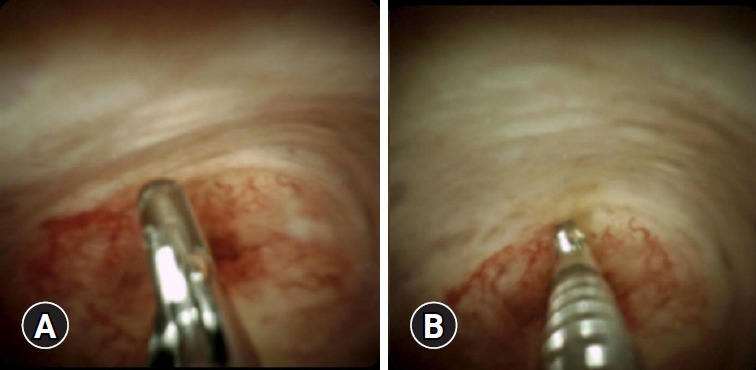 Peroral cholangioscopy: past, present and future.