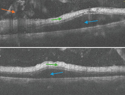 Combined Cytomegalovirus Retinitis and Vitreous Hemorrhage in an Immunocompromised Patient.