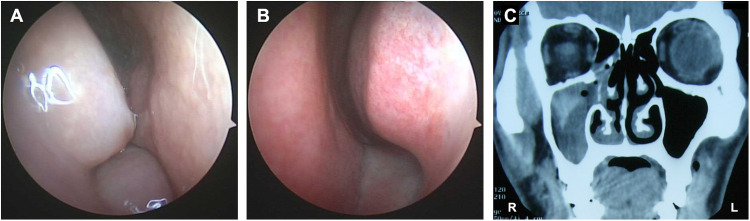 Clinical characteristics and treatment of unilateral allergic fungal rhinosinusitis: a retrospective case series and literature review.