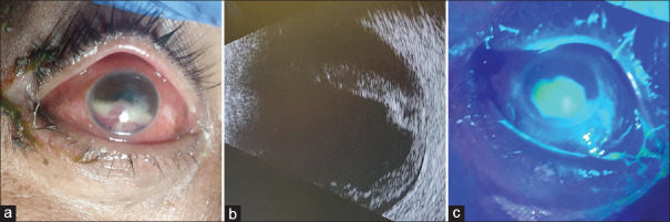 <i>Purpureocillium lilacinum</i> keratitis in a methamphetamine user: Case report.