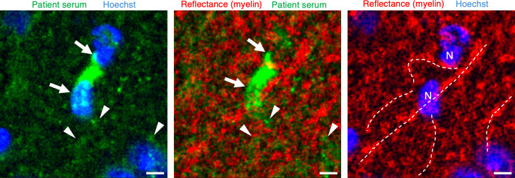 Serum immunoreactivity to neurofilament-medium shows high sensitivity and specificity in patients with Behçet disease.