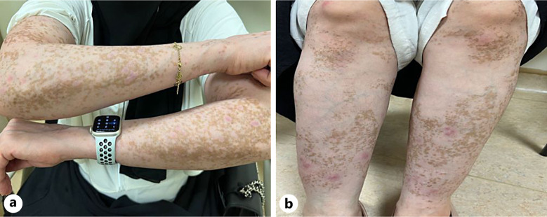 Dupilumab's Successful Journey in Pityriasis Lichenoides Chronica Followed by the Intriguing Reemergence of Vitiligo after Monobenzone Depigmentation: A Case Report.