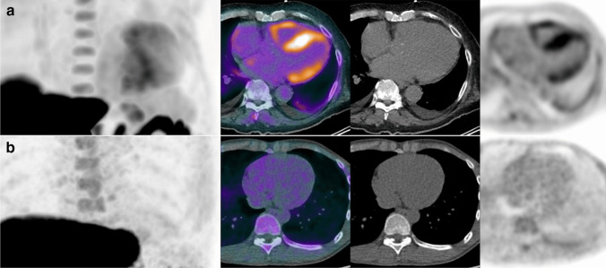 Positron emission tomography in cardiac amyloidosis: current evidence and future directions.