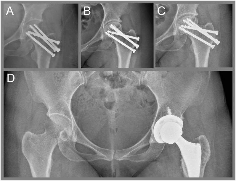 Depot medroxyprogesterone acetate (DMPA)-associated early-onset osteoporotic fracture.