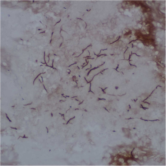 Clinical characteristics and treatment of unilateral allergic fungal rhinosinusitis: a retrospective case series and literature review.