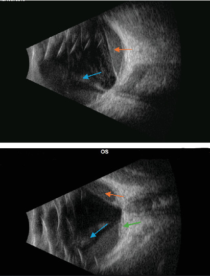 Combined Cytomegalovirus Retinitis and Vitreous Hemorrhage in an Immunocompromised Patient.