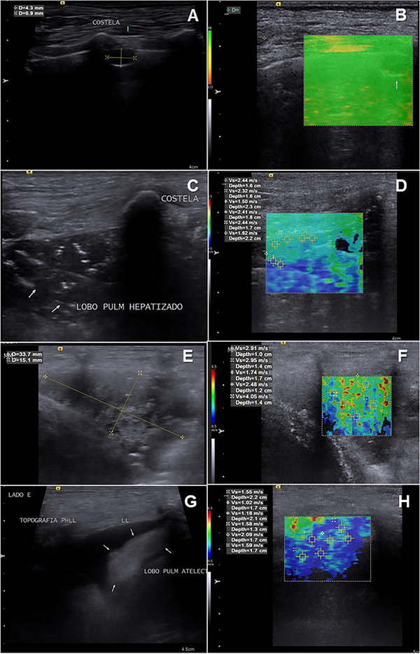 Acoustic Radiation Force Impulse Elastographic Study of Lung Lesions in Dogs.