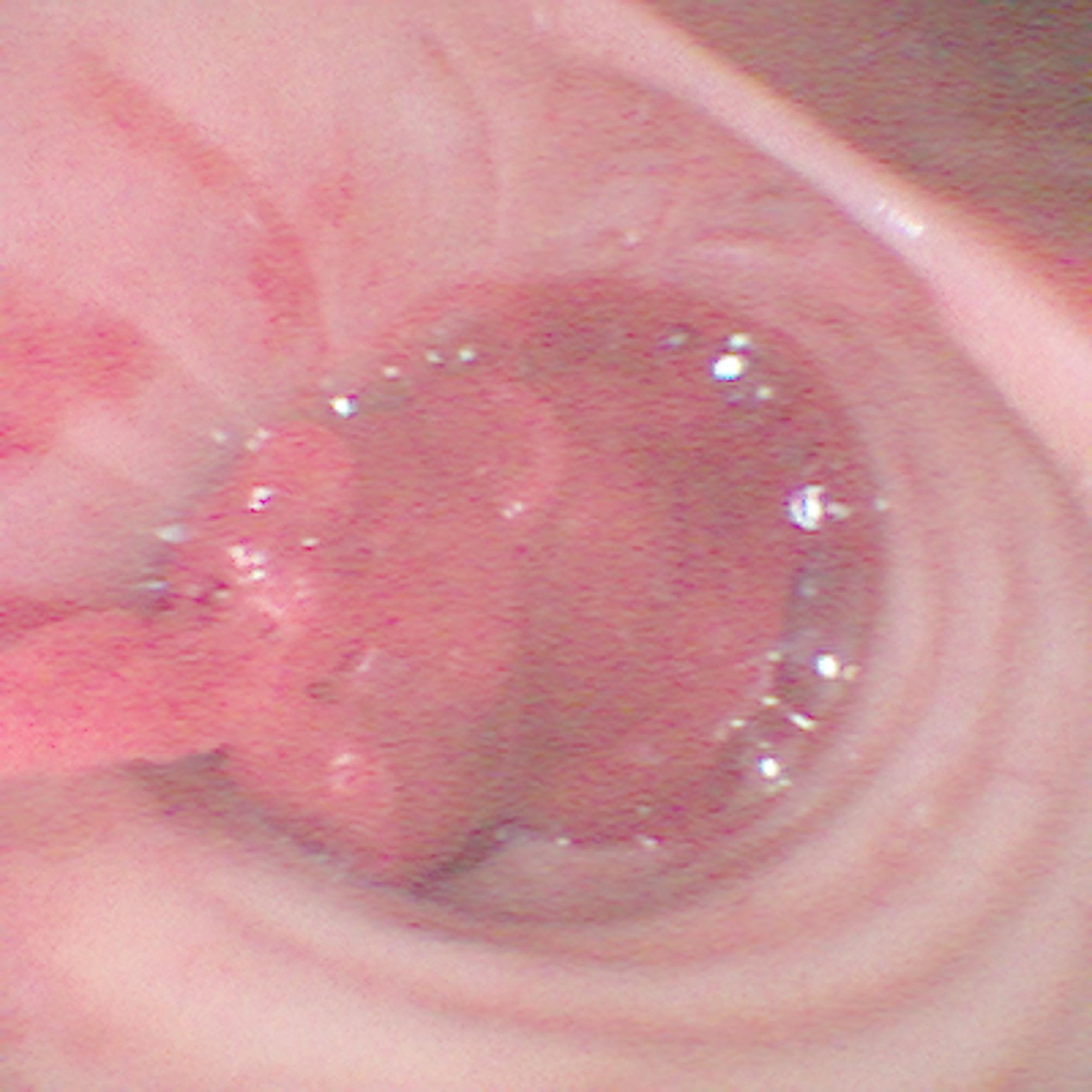 Unperceived bronchial bleeding complications during percutaneous dilatational tracheotomy: a case report and 3D simulation.