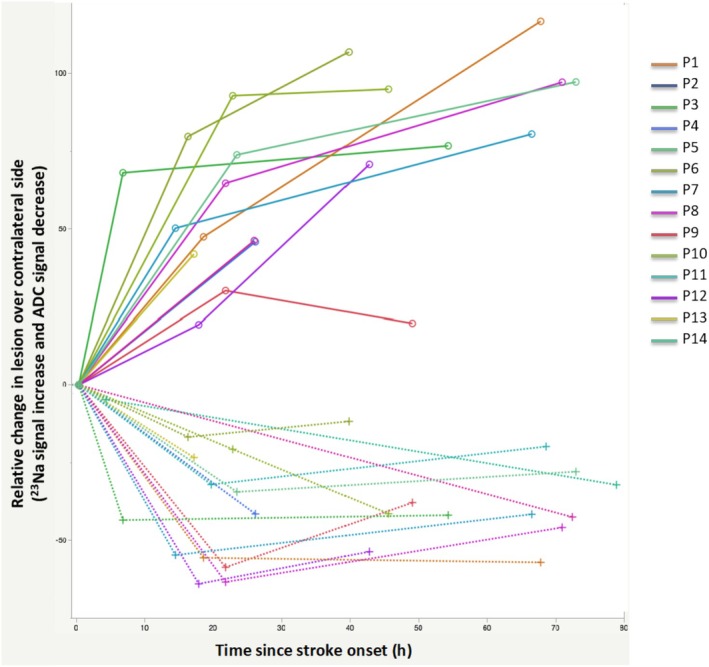Dynamics of Ionic and Cytotoxic Edema During Acute and Subacute Stages of Patients With Ischemic Stroke: Complementarity of <sup>23</sup>Na MRI and Diffusion MRI.