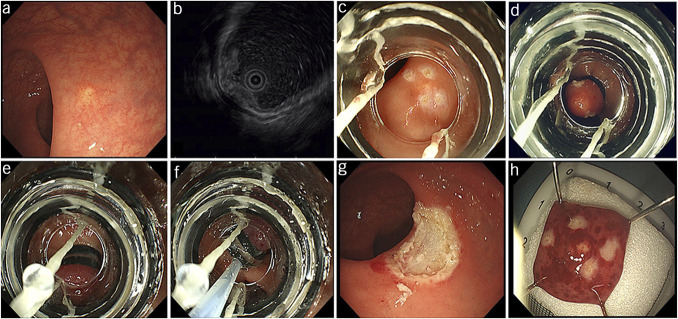 Double Band Ligation-Assisted Endoscopic Submucosal Resection for Rectal Neuroendocrine Tumors: Comparison With Conventional Endoscopic Mucosal Resection With Ligation (With Video).
