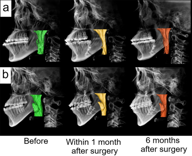 Effects of mandibular setback surgery using the surgery-first approach versus conventional orthognathic approach on upper airway change and sleep quality.