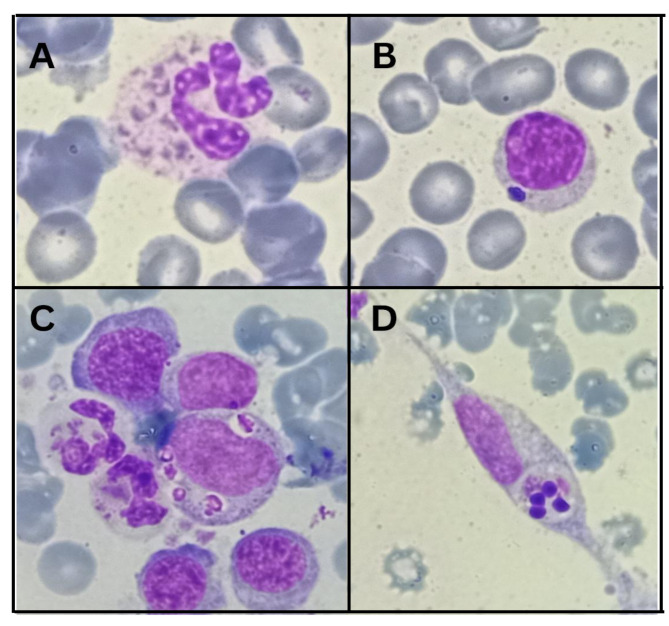 Comprehensive analysis of a novel LYST mutation in a Tunisian patient with Chediak-Higashi syndrome.