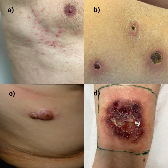 Retrospective Evaluation of Clinical and Follow-Up Outcomes in Primary Cutaneous CD30<sup>+</sup> Lymphoproliferative Disorders