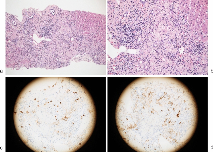 A clinicopathological study of IgG4-related autoimmune hepatitis and IgG4-hepatopathy.