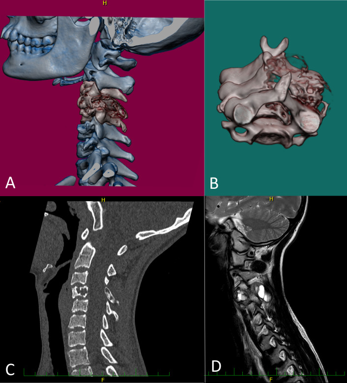 Novel and unusual <i>USP6</i> fusion partners in aneurysmal bone cyst and their role in pathogenesis and histopathological evaluation of this disease.