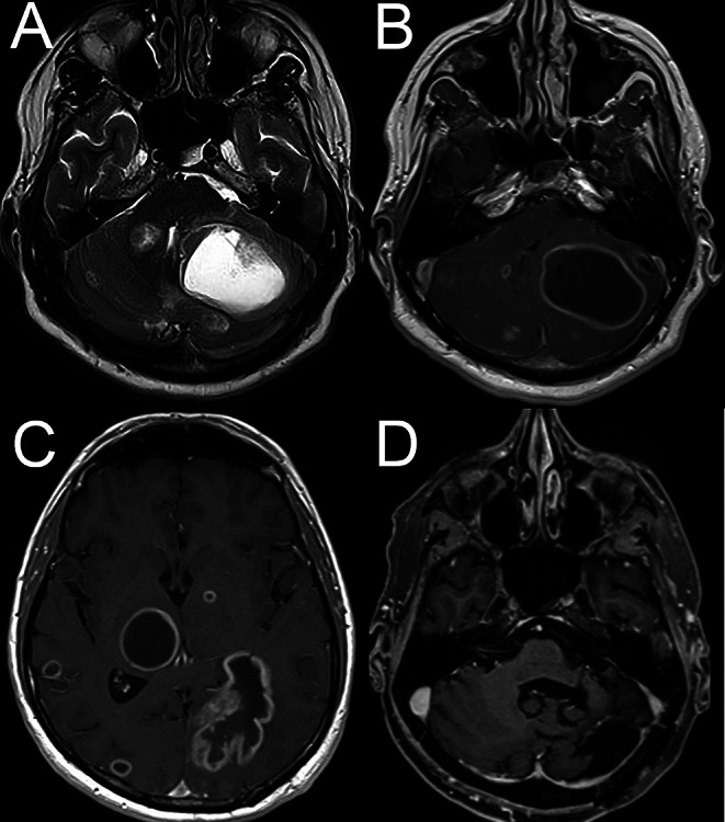 Transient Response to Liberation Maneuvers in Central Positional Nystagmus Due to Cerebral Metastases Mimicking Benign Paroxysmal Positional Vertigo- A Case Report.