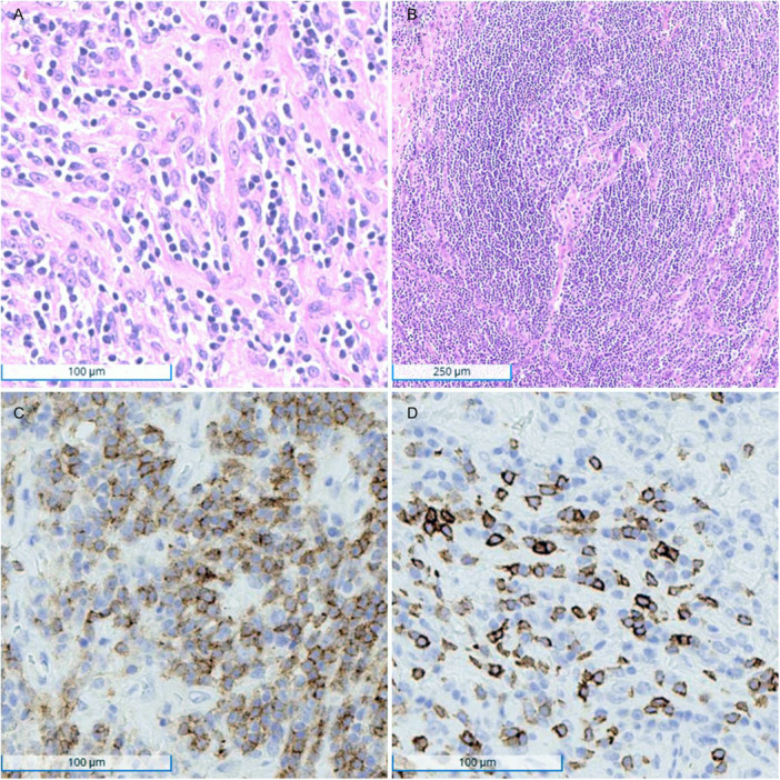Follicular Dendritic Cell Sarcoma of the Parapharyngeal Space Arising in Association With Castleman Disease.