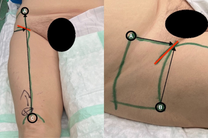 Surgical procedure and retrospective comparative series of Microport's AnteriorPath<sup>®</sup> vs. AMIS<sup>®</sup> in total hip arthroplasty. Preliminary findings from a single institution.