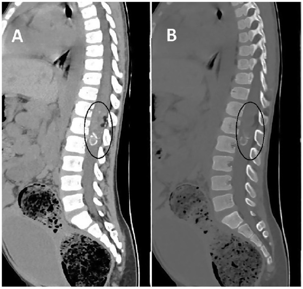 Intradural-Intramedullary Spinal Teratoma with Syrinx Formation: A Case Report.